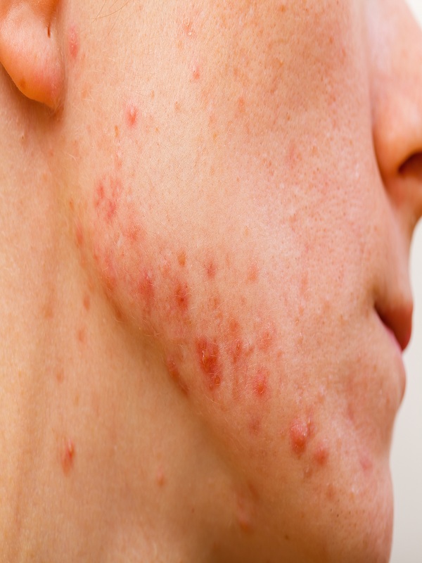 Acne Vulgaris