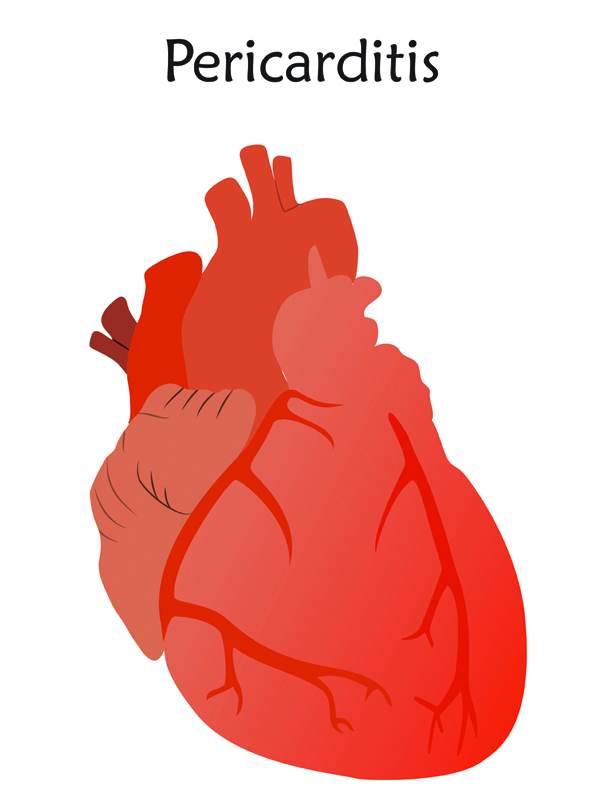 Acute Pericarditis