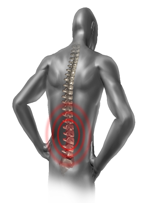 Ankylosing Spondylitis